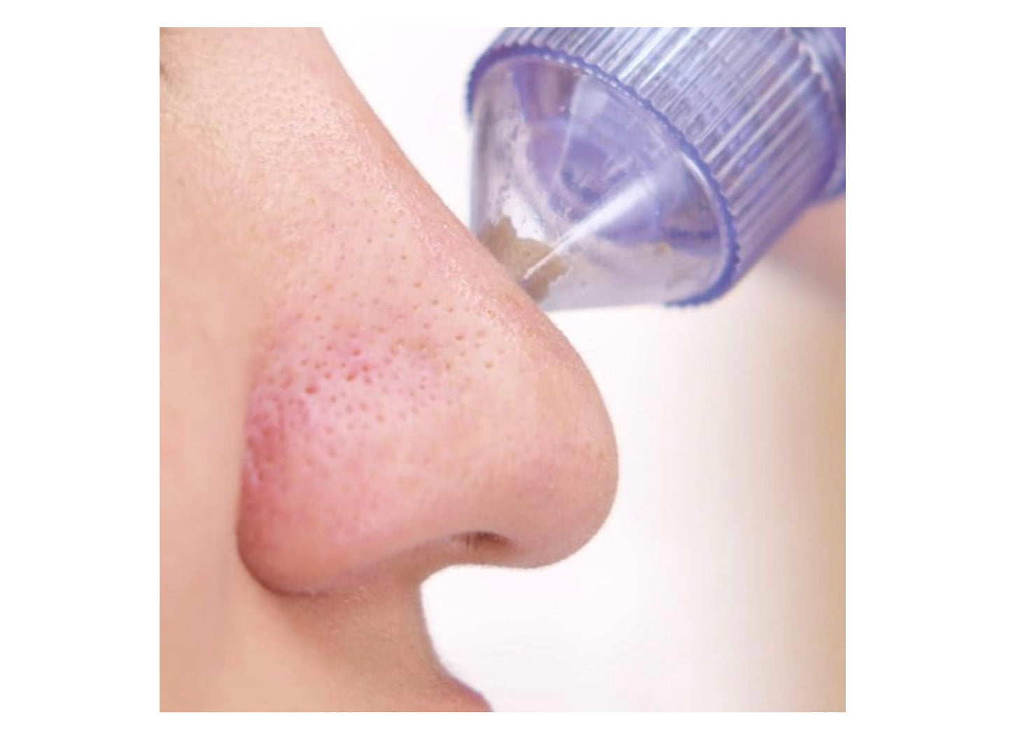 Rechargeable Blackhead Remover – Pore Vacuum & Skincare Device